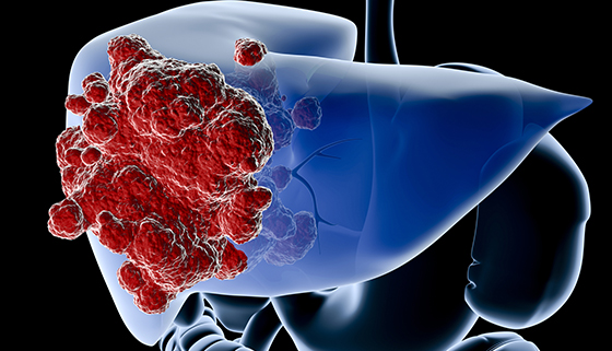 A diagram showing the liver in blue and a cancer in red Digital medical illustration: Perspective x-ray view of human liver with tumor. Anatomically correct. Isolated on black.