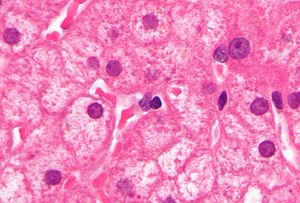 300px-Ground_glass_hepatocytes_high_mag_cropped